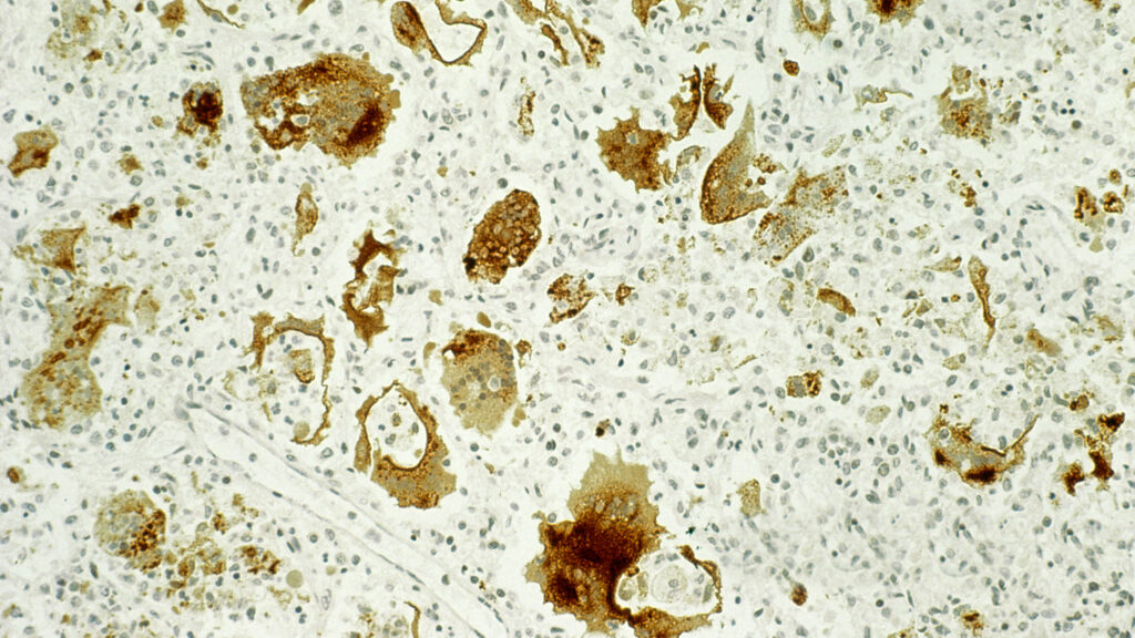 The pain of even ‘mild’ cases of measles, pertussis, and more