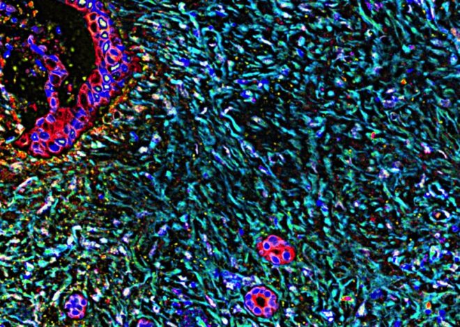 Expert analyzes potential new pancreatic cancer breakthrough